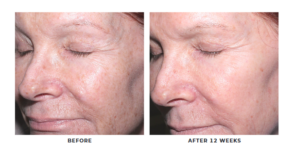 Refine + Renew Retinol 5 Gelée Serum