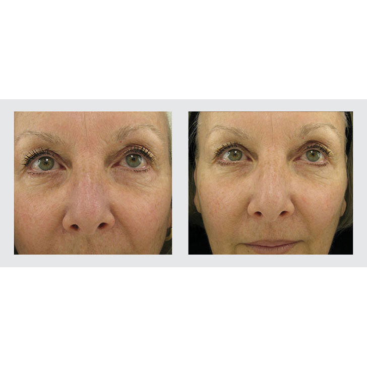 Lift & Volume Restoration Duo