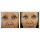 Lift & Volume Restoration Duo